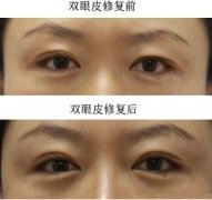刘凤卓做双眼皮修复好吗？多少钱？