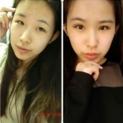 武汉双眼皮修复手术哪家医院做的最好？