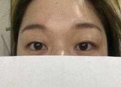 上海九院刘南琳做的全切双眼皮手术