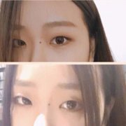 广州美莱做的双眼皮开眼角提肌