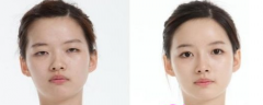 徐州华美割双眼皮的价格？