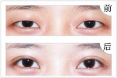遵义利美康微创双眼皮手术价格一般要多少钱？