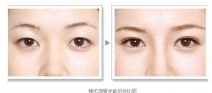 太原哪家医院做韩式双眼皮手术最好？