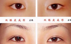 大连切双眼皮哪最好解放军403医院
