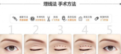 求问杭州时光吕敏专家：埋线双眼皮线头外露怎