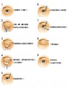 广州军美做上眼皮吸脂多少钱？