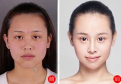 贵阳美贝尔割双眼皮价格是多少钱？