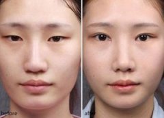 民航广州医院整形割双眼皮好不好呢？