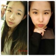 南昌爱思特割双眼皮多少钱？