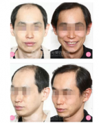 广州曙光植发大概花费多少钱?效果怎么样