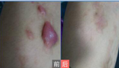 重庆华美整形医院祛疤效果怎么样？哪个专家好