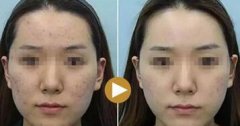 大连新华美天整形医院做祛斑好吗?