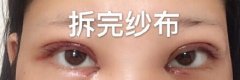 四川广元朗睿整形医院刘锋双眼皮+开眼角
