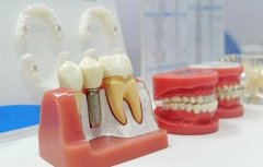 南京三甲医院种牙多少钱?附真实收费表避坑