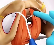 3d生物束带和传统紧缩术哪个好？真实案例速看
