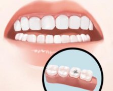 广州种植牙医院排名如何?本地人实测推荐