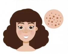 皮秒祛斑10天变化:记录手术前后变化