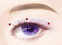 重庆割双眼皮医生排名如何?本地好医生排名