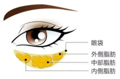 眼袋手术1--10天图片:每日恢复详细记录