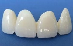 300元1颗的烤瓷牙图片如何?查看恢复详情