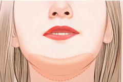 玻尿酸丰下巴会变宽吗?优势和基本认知得知道