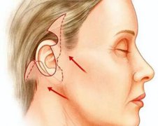 做7d聚拉提痛不痛?真实体验+避坑指南来了