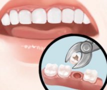 种植牙多少钱一颗？费用明细参考，别犹豫