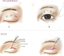 肿眼泡抽脂前后对比照片咋样?手术全过程更新