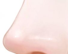 鼻骨内推前后对比照如何?附恢复过程全记录