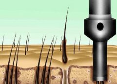 植发2一6个月效果图如何？附详细案例过程