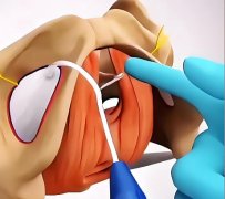 3d生物束带紧缩术效果好吗？内附真实效果数据