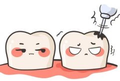 番禺种牙避坑指南：收费明细+隐藏优惠全扒光