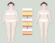 做火凤凰溶脂要多久？这3个阶段藏着变瘦关键