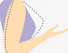 抽脂去副乳|先搞懂价格再谈风险