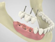 深覆合矫正多长时间?