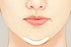 万和假体和威宁假体|细节对比填下巴优势