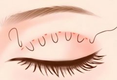 埋线双眼皮拆线后能恢复原样吗?这3个细节注意