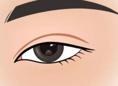 做埋线双眼皮价格多少?影响因素一一分析