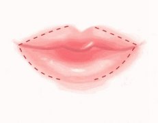 微笑唇整形多少钱?直接给答案