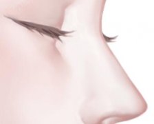驼峰鼻矫正术的术后咋样?想要漂亮鼻快来