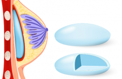 伊思雅假体隆胸能永远存放体内吗？过来人实测