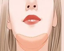 自体脂肪填下巴贵吗？内行人扒清价格门道，看完不花冤枉钱