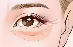 外路祛眼袋是什么效果？内行人说清真实表现