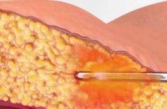 环吸手术多少钱？影响费用的5大关键因素全解析了