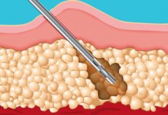快速减肥方法小妙招有哪些？7天瘦5斤不反弹，亲测有效