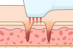 光子祛斑和激光祛斑的区别有哪些？看看哪个才是你的美白神器